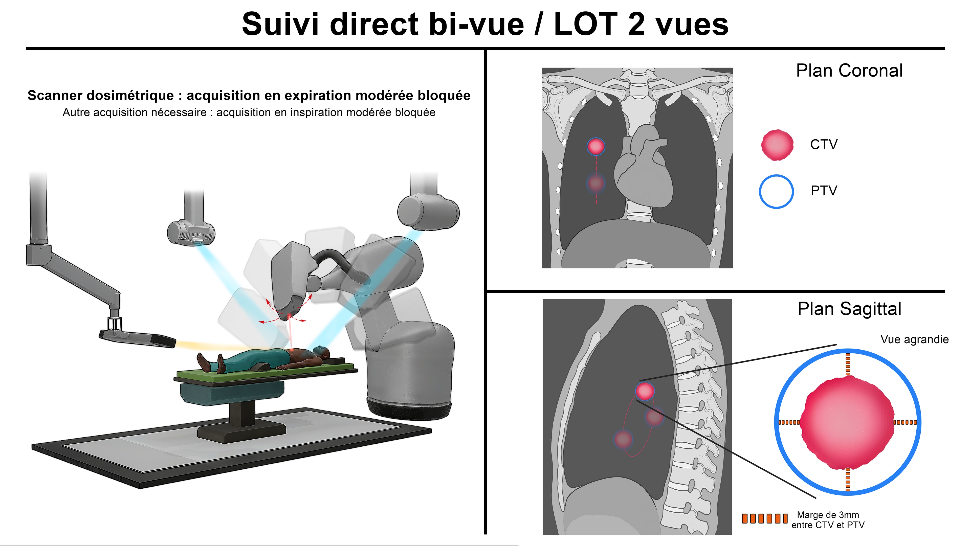 Thèse Comparatif Cyberknife par LucasG
