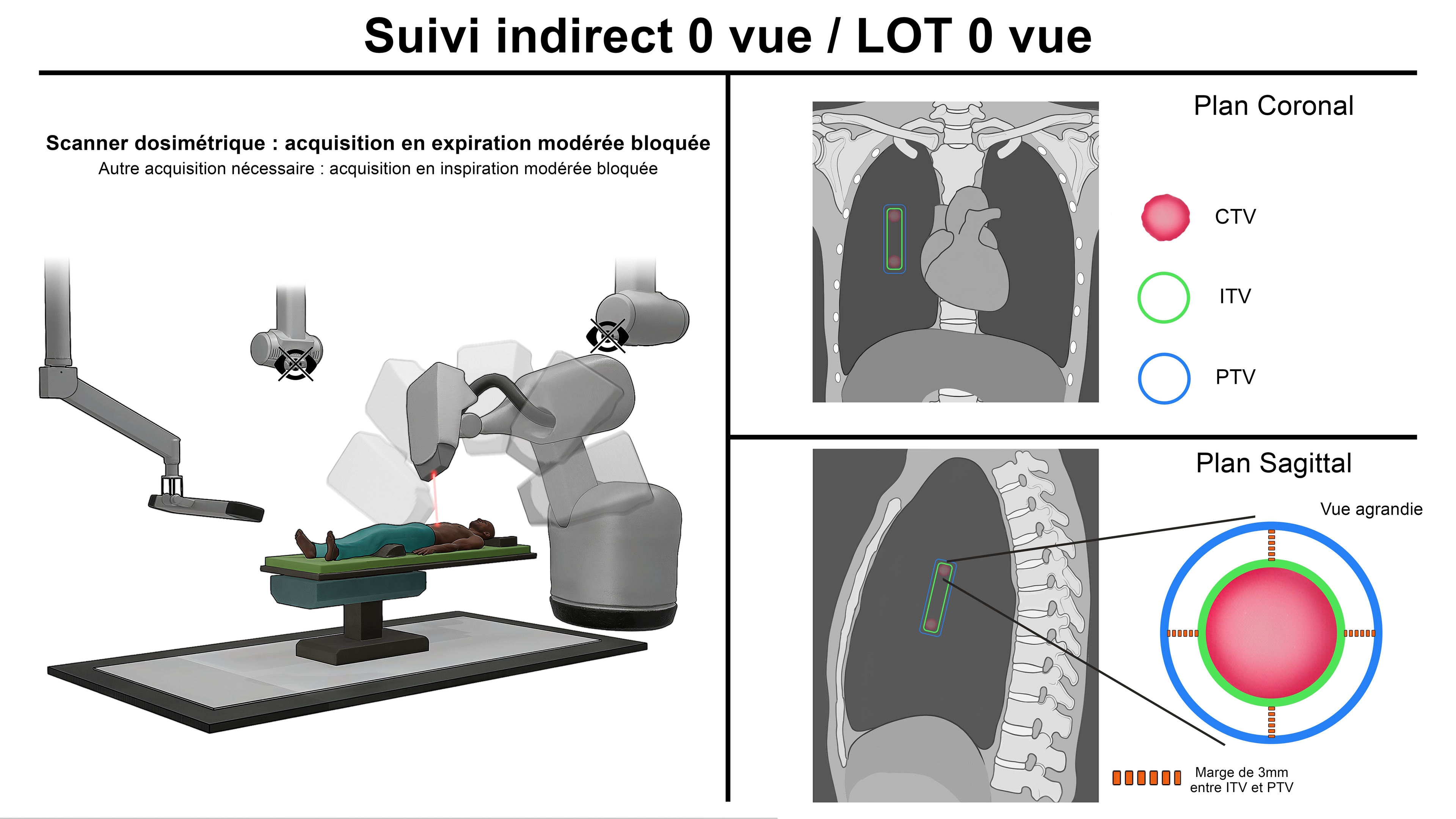 Thèse Comparatif Cyberknife par LucasG