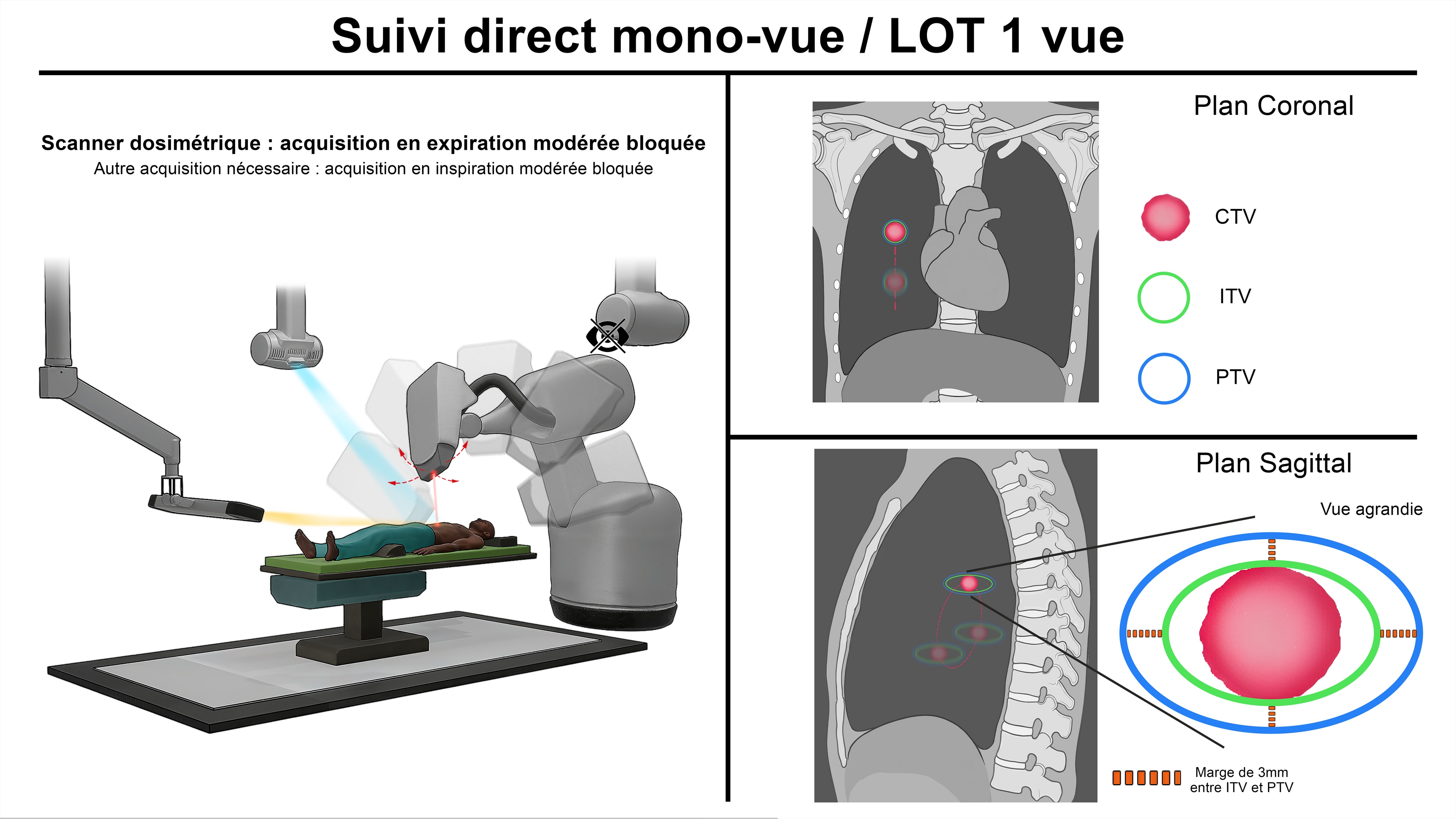 Thèse Comparatif Cyberknife par LucasG